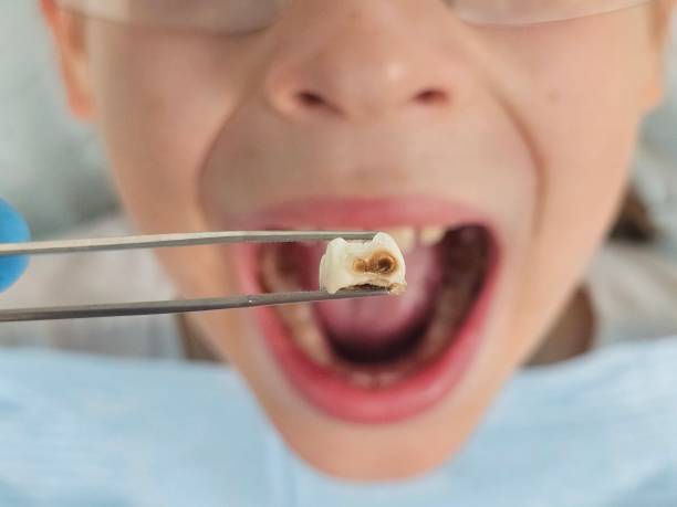 Best Broken or Cracked Tooth Emergency Dentist in Whitney, TX